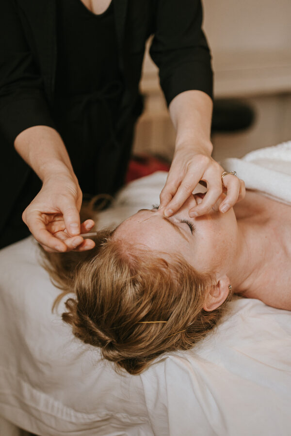 Client receiving acupuncture treatment at point above their nose