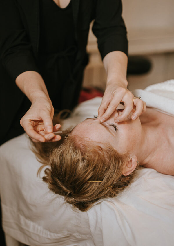 Client receiving acupuncture treatment at point above their nose