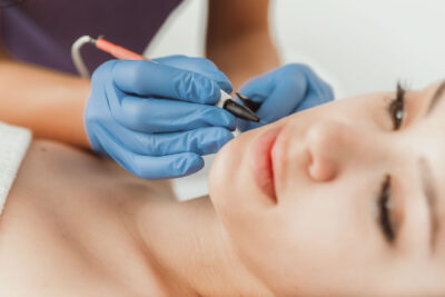 Aesthetician's gloved hands applying electrolysis treatment to side of woman's face