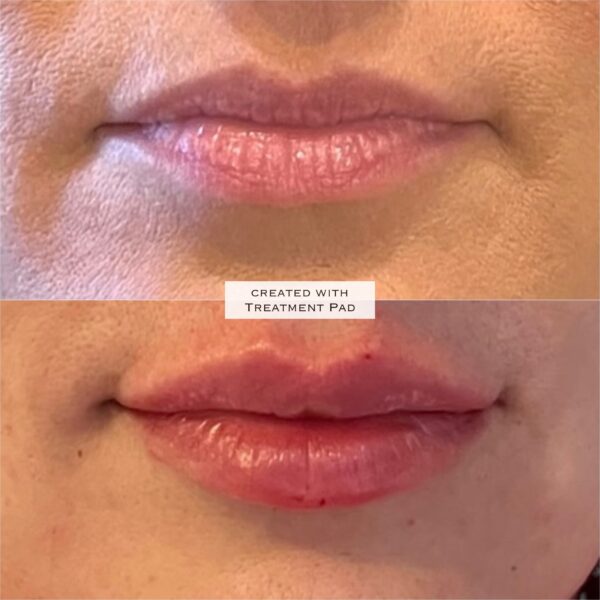 Before and after results of lip filler treatment created with treatment pad