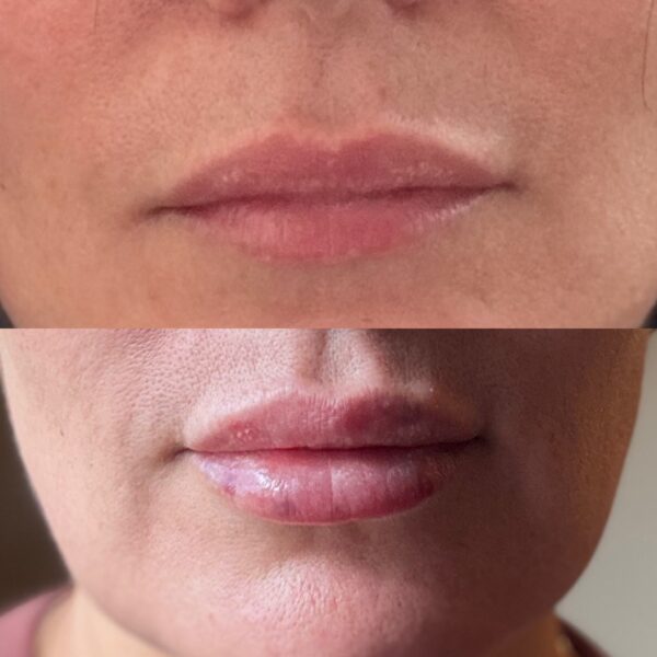 Before and after results of lip filler treatment